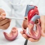 Pemasangan Stent Jantung