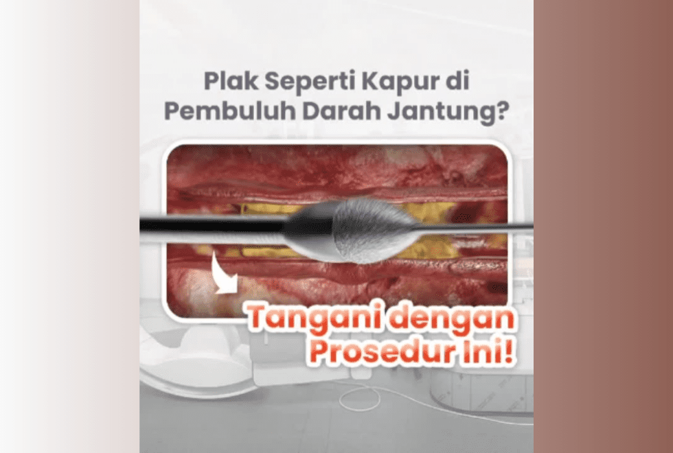 Solusi untuk Plak Kalsifikasi