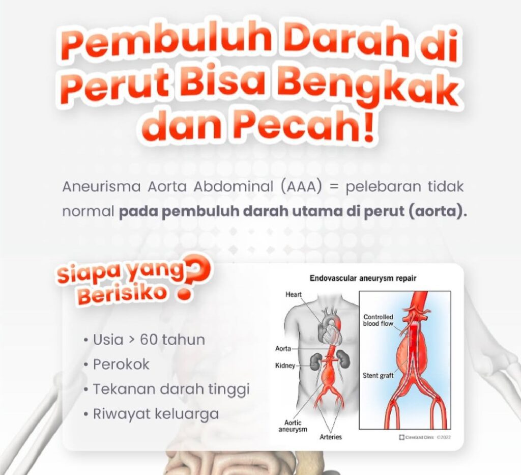 Waspada "Silent Killer" di Perut Anda: Mengenal Aneurisma Aorta ...