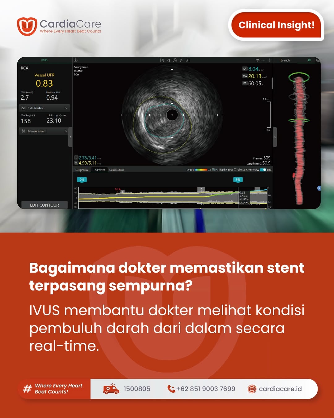 Optimasi Pemasangan Stent Jantung dengan IVUS: Teknologi Presisi untuk Hasil Maksimal