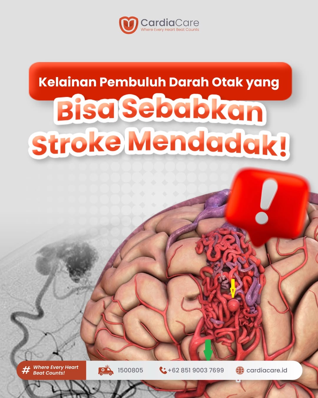 Mengenal Cerebral AVM: Kelainan Pembuluh Darah Otak yang Memicu Stroke Mendadak