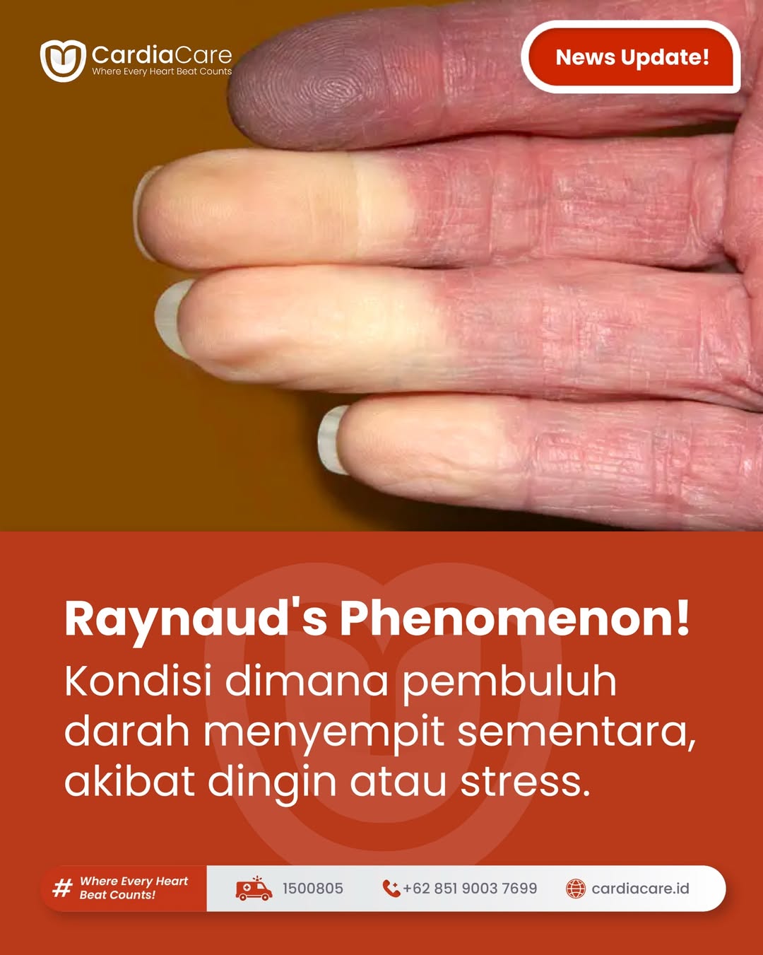 Jari Tangan Pucat dan Dingin? Kenali Fenomena Raynaud dan Kapan Harus Waspada
