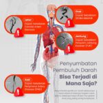 Waspada Aterosklerosis Sistemik: Penyumbatan Pembuluh Darah Ternyata Bisa Terjadi di Mana Saja, Tidak Hanya Jantung