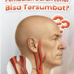 Waspada Penyempitan Pembuluh Darah Leher (Carotid Artery Stenosis): Ancaman Siluman Pemicu Stroke