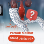 Mengenal Stent Graft dan Prosedur EVAR untuk Penanganan Aneurisma Aorta Abdominal (AAA)