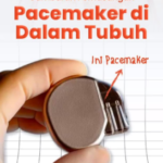 Pacemaker (Alat Pacu Jantung): Solusi Medis untuk Gangguan Irama Jantung (Bradikardia)