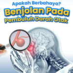 Menguak ‘Bom Waktu’ Aneurisma Otak dan Peran Vital Digital Subtraction Angiography (DSA) dalam Diagnosis Presisi