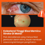 Awas! Kolesterol Tinggi Bisa Picu ‘Stroke Mata’ (Retinal Artery Occlusion) Hingga Kebutaan Mendadak