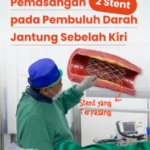 Prosedur Pasang Ring Jantung (Stent) Koroner: Mengapa Terkadang Butuh Lebih dari Satu?