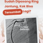Sudah Pasang Ring Jantung, Kenapa Pembuluh Darah Bisa Menyempit Lagi?