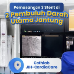 Penanganan Penyakit Jantung Koroner Multivessel Disease: Pemasangan 3 Stent pada LAD dan LCx
