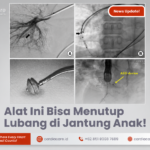 Mengenal Device Closure: Prosedur Penutup Lubang Jantung Bawaan pada Anak Tanpa Operasi Terbuka