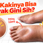 Mengenal Pitting Edema pada Kaki: Kapan Menjadi Tanda Gagal Jantung?