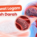 Penanganan Aneurisma Otak Tanpa Operasi Buka Tengkorak dengan Metode Coiling
