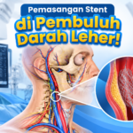 Cegah Stroke: Pemasangan Stent untuk Mengatasi Sumbatan Pembuluh Darah Leher (Arteri Karotis)